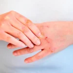Psoriasi o dermatite? Ecco il dettaglio fondamentale per non confonderle