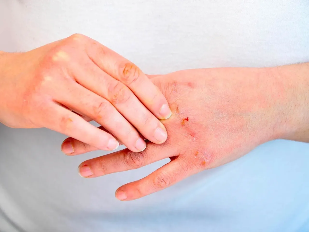 Psoriasi o dermatite? Ecco il dettaglio fondamentale per non confonderle